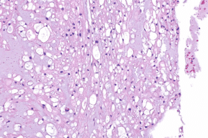 Guide 5 Key Signs Of Acute Lupus Erythematosus