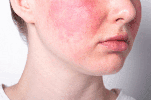 Complete 7 Skin Lesions In Lupus Erythematosus