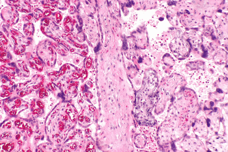 Insightful Types Of Cutaneous Lupus Rashes & Symptoms