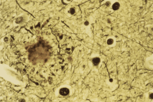 Amyloidosis Protein Type AA: Key Differences from AL Explained