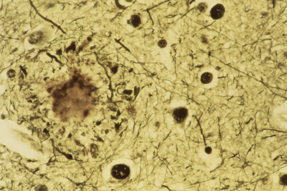 Amyloidosis Protein Type AA: Key Differences from AL Explained