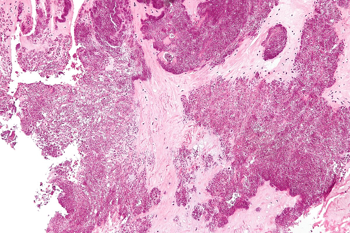 Key 7 Best Foods To Avoid With Chondrocalcinosis Diet