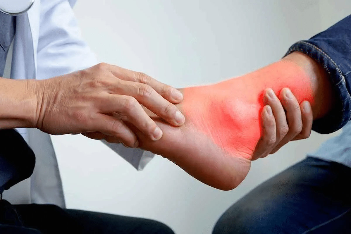 Ultimate Guide: How To Take Colchicine For Acute Gout