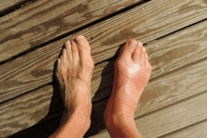 Crucial Relief: How Does Colchicine Work For Gout?