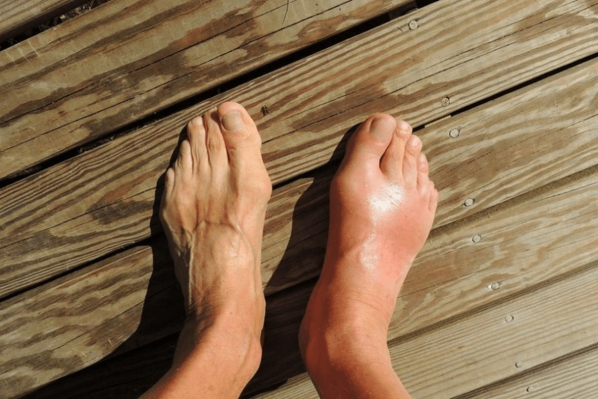 Crucial Relief: How Does Colchicine Work For Gout?
