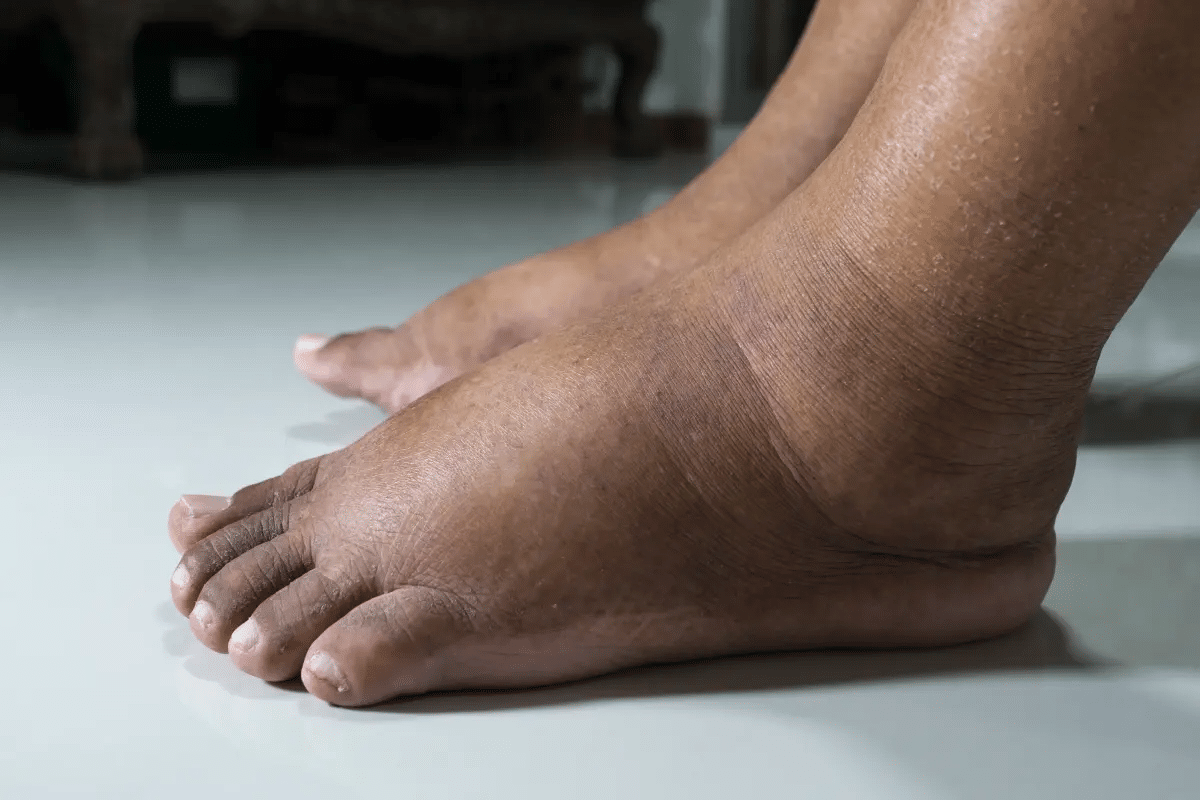 Guide How To Treat Swollen Veins In Feet & Ankles 2 Guide How To Treat Swollen Veins In Feet & Ankles