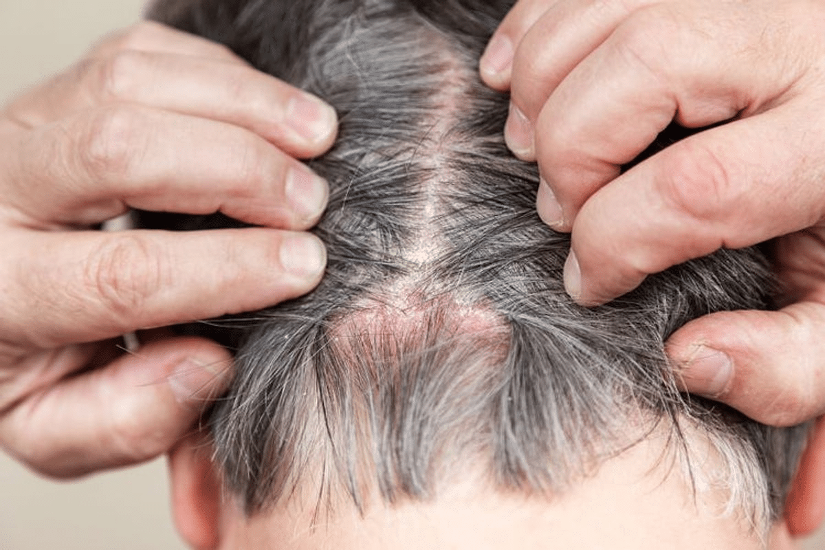 Simple Does Lupus Hair Loss Cause Permanent Damage?
