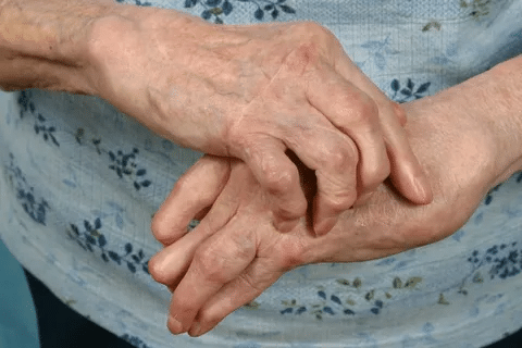Amazing Does Rheumatoid Arthritis Cause Muscle Pain?