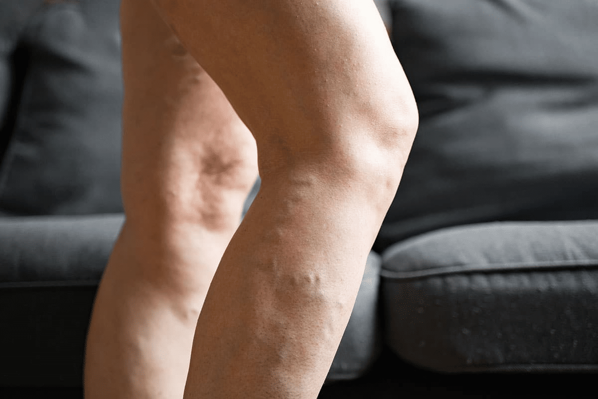 Valuable Complete Guide: How To Treat Varicose Veins