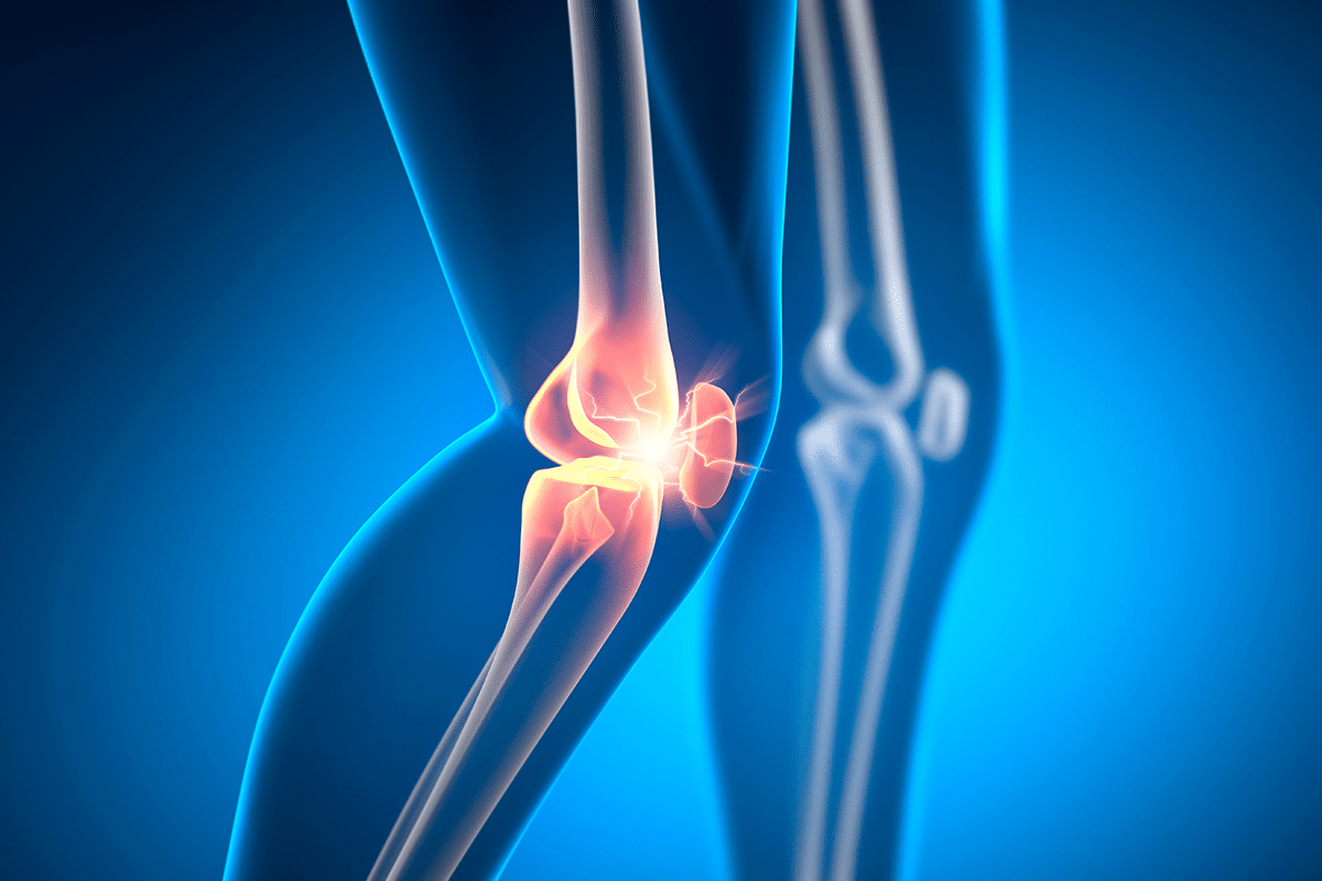 Insightful What Is Meniscal Chondrocalcinosis: Diagnosis 3 Insightful What Is Meniscal Chondrocalcinosis: Diagnosis
