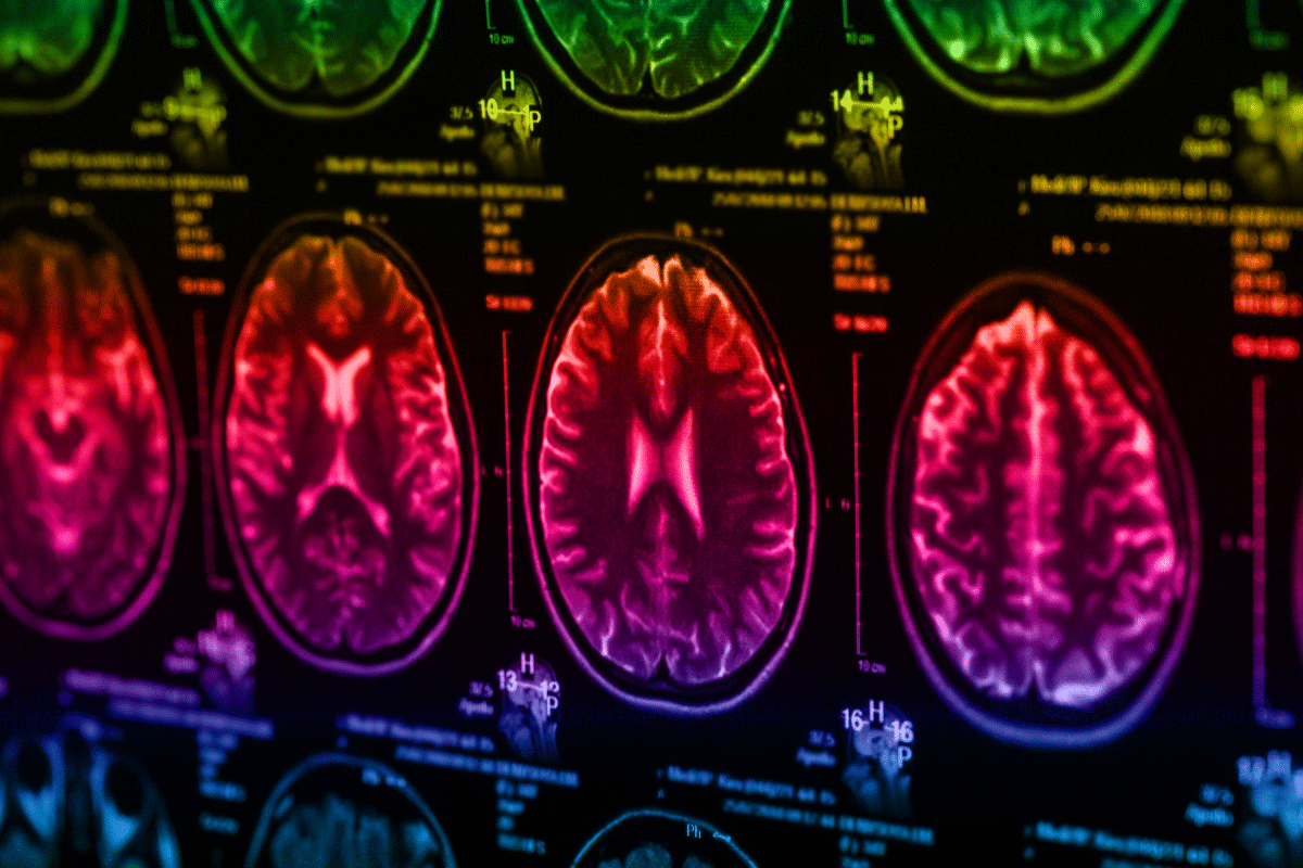 Fascinating Main Risk Factors For Multiple Sclerosis