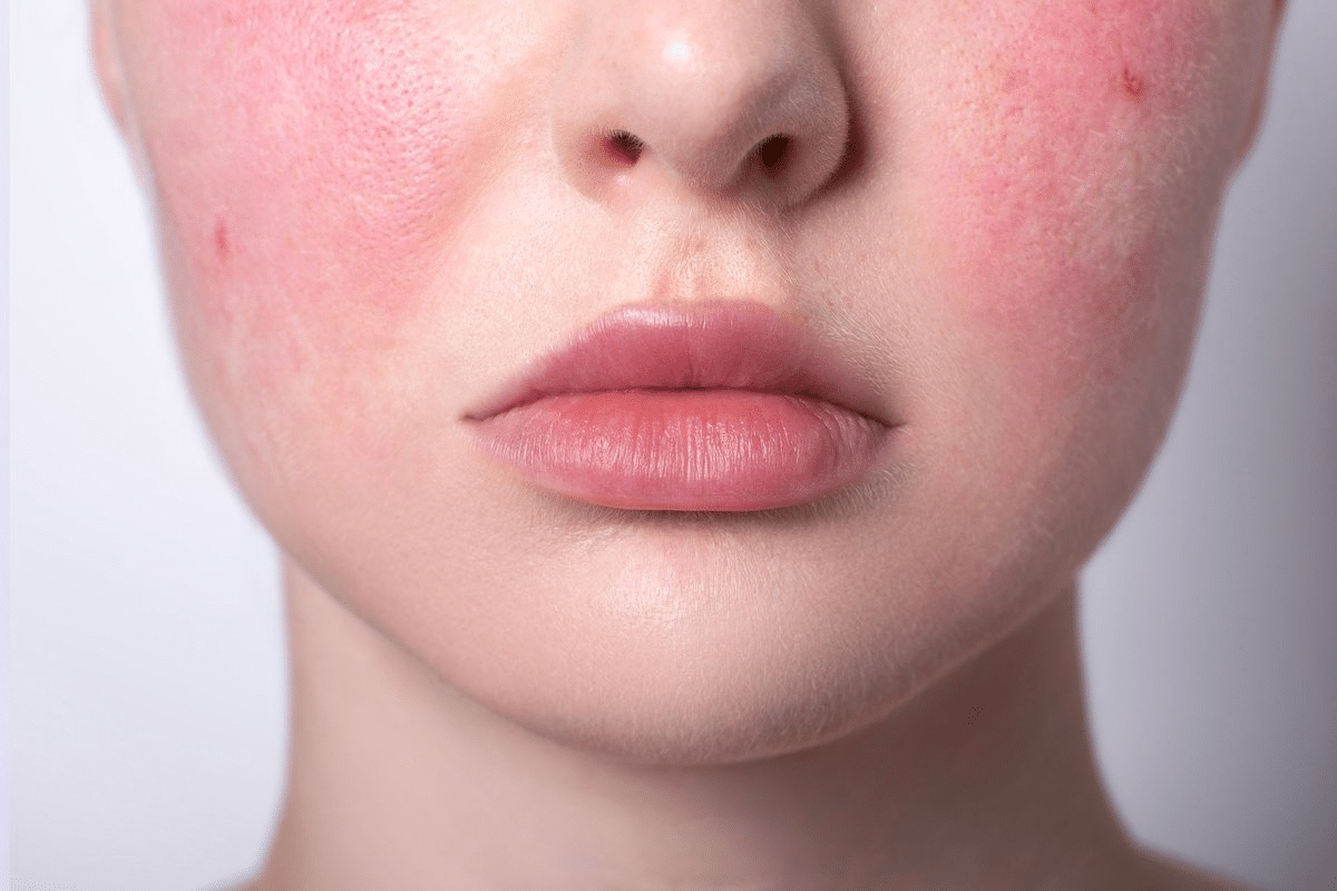 Sharp Step-by-Step Leukocytoclastic Vasculitis Treatment 3 Sharp Step-by-Step Leukocytoclastic Vasculitis Treatment