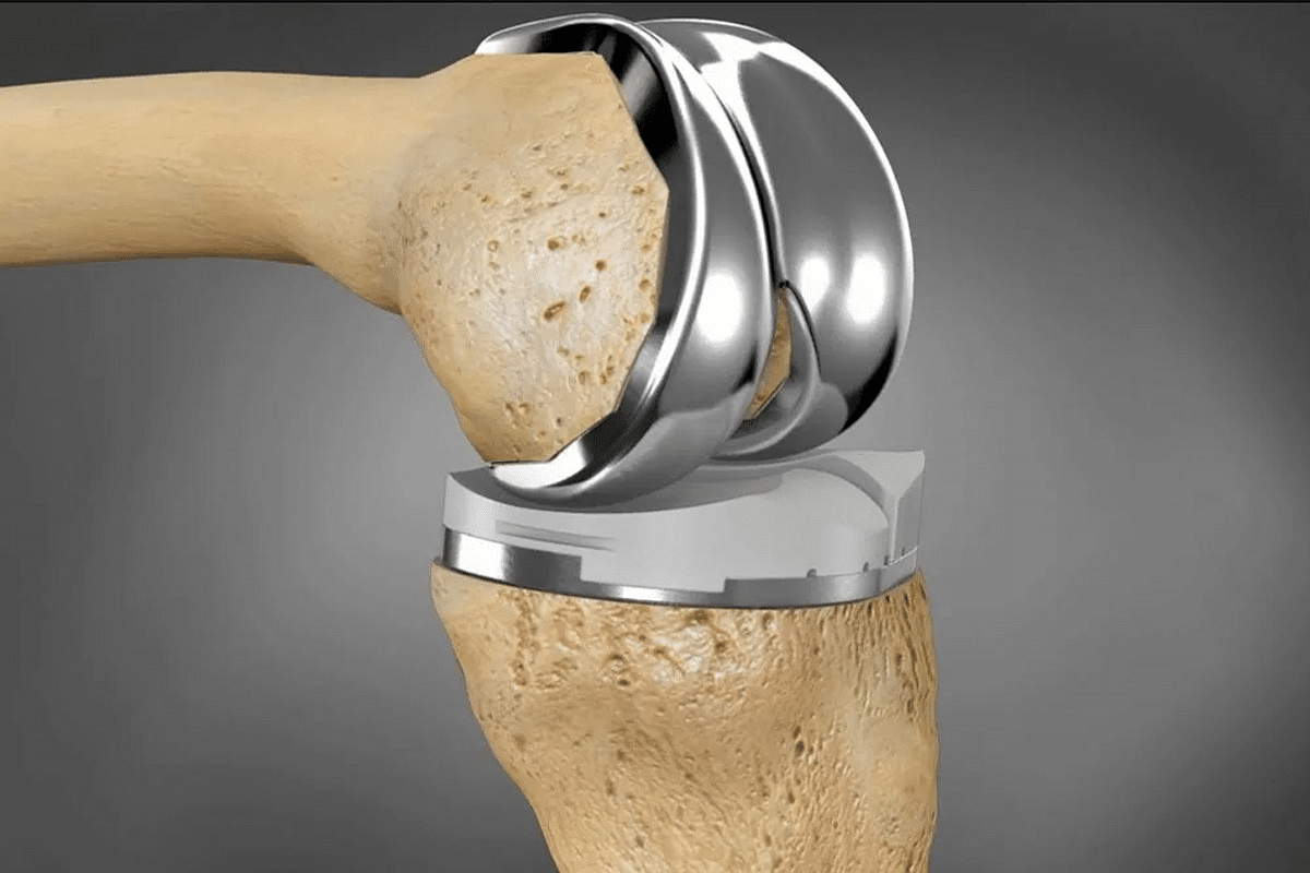 Crucial How To Use IV Infusion For Osteoporosis Treatment