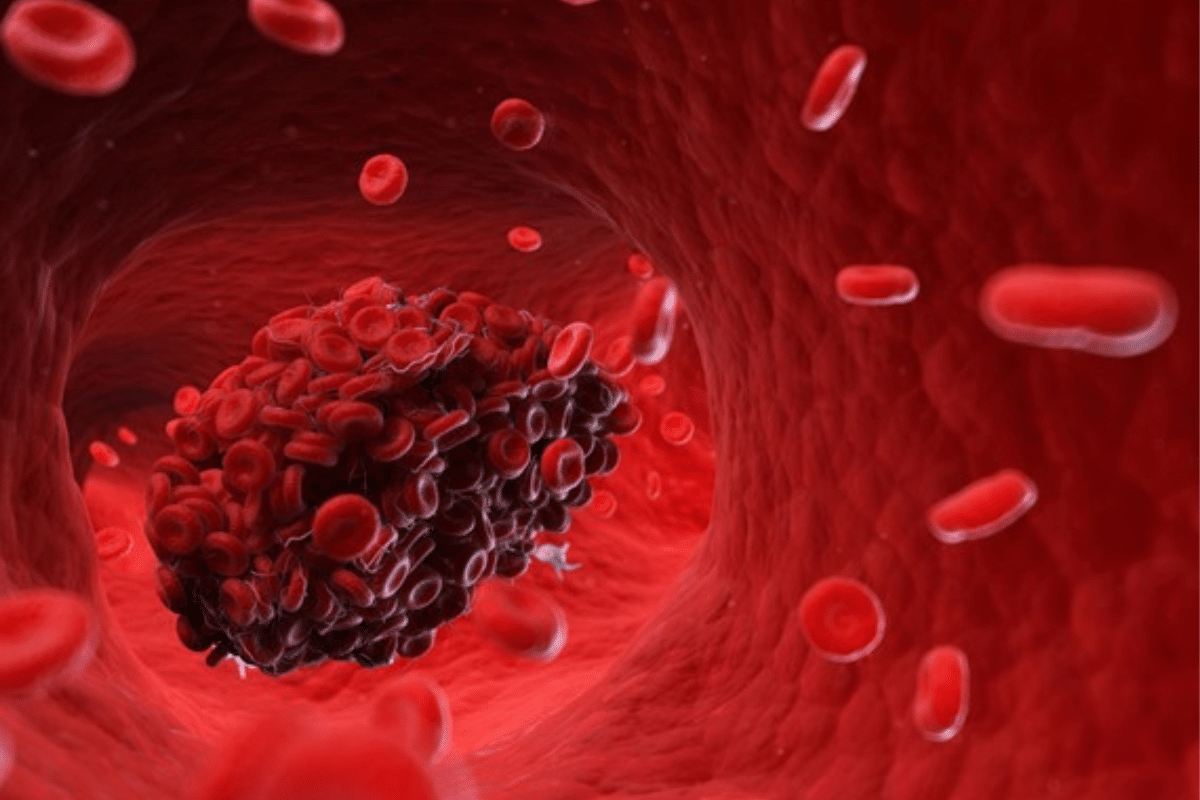 Sharp Step-by-Step Leukocytoclastic Vasculitis Treatment 1 Sharp Step-by-Step Leukocytoclastic Vasculitis Treatment