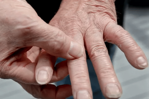 Profound 7 Best Alternative Therapies For Rheumatoid Arthritis