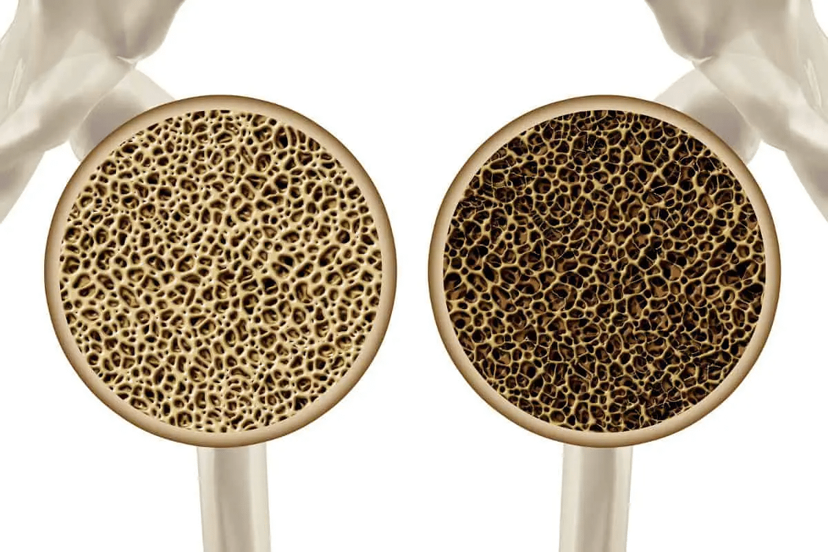 Guide How To Use IV For Osteoporosis Treatment