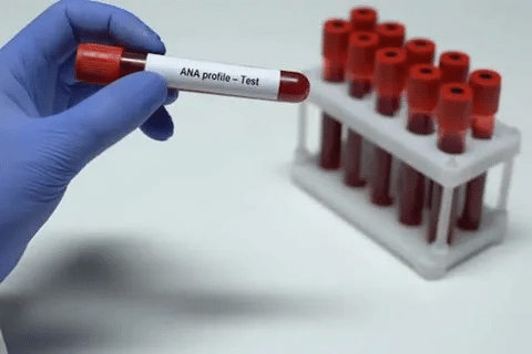Complete What Is An ANA Test And What Results Mean?