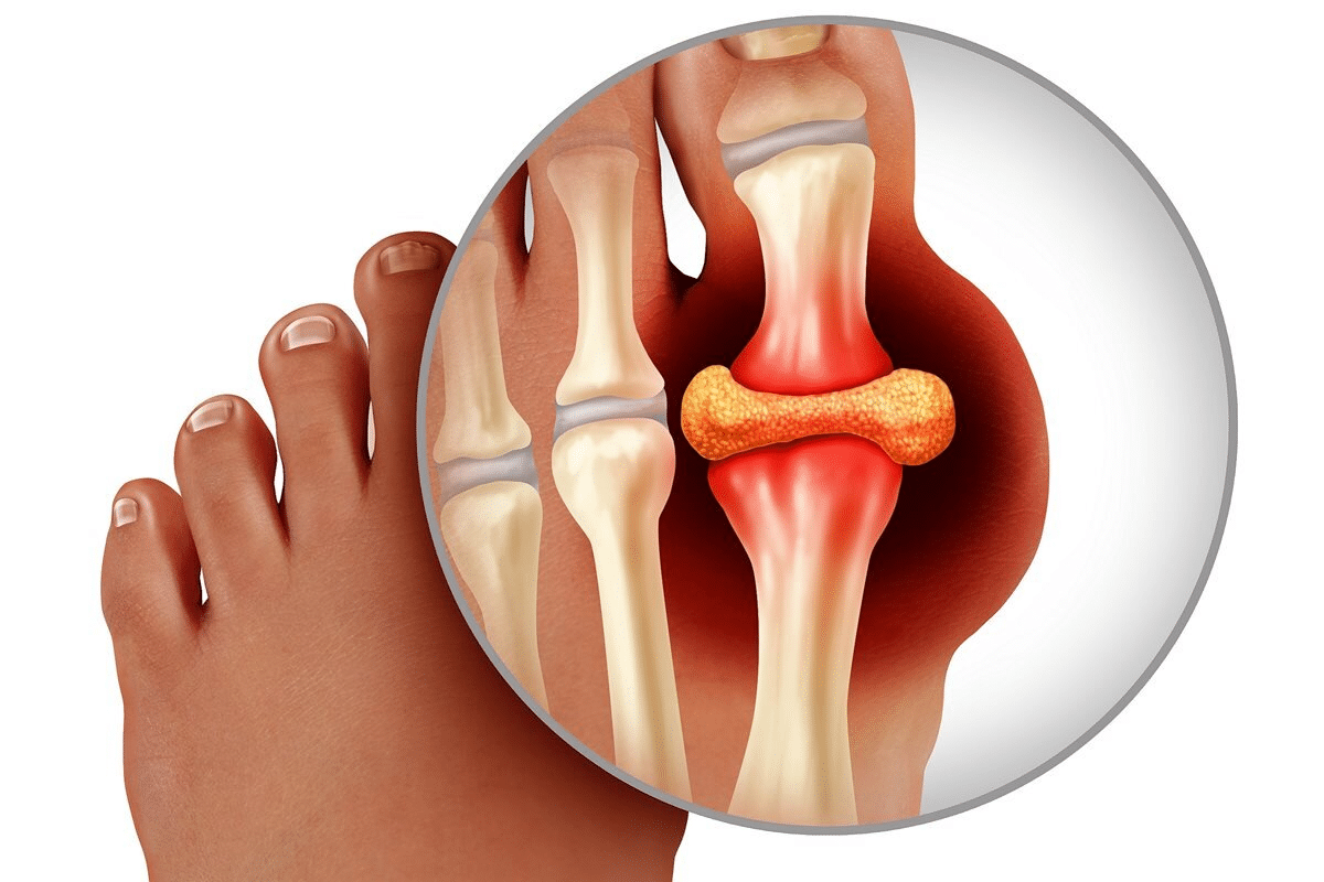 Complete Allopurinol Vs Colchicine: Which Is Better For Gout?