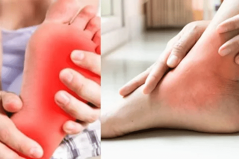 Profound Taking Allopurinol During A Gout Attack Rule