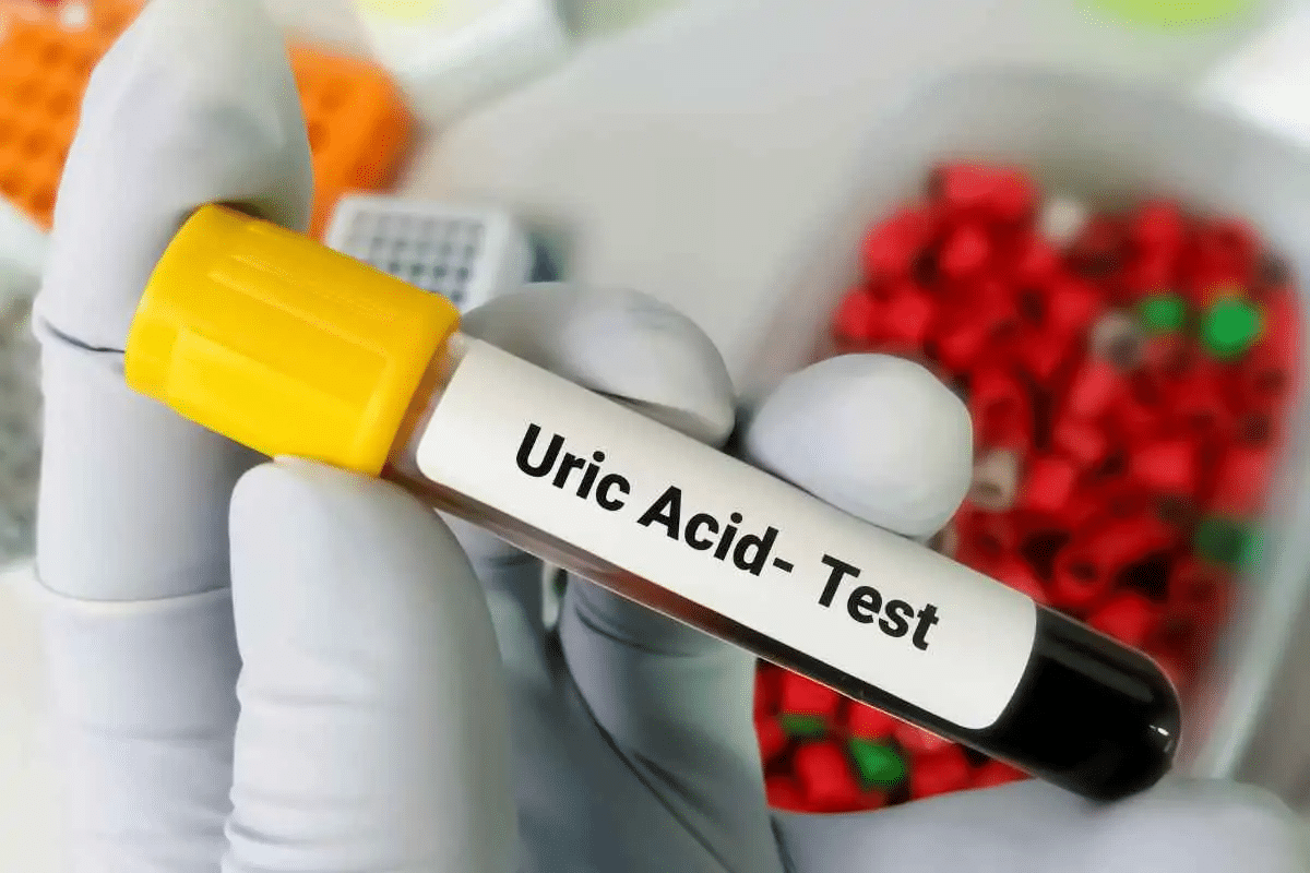 Valuable How Long Does Allopurinol Take To Work For Gout?