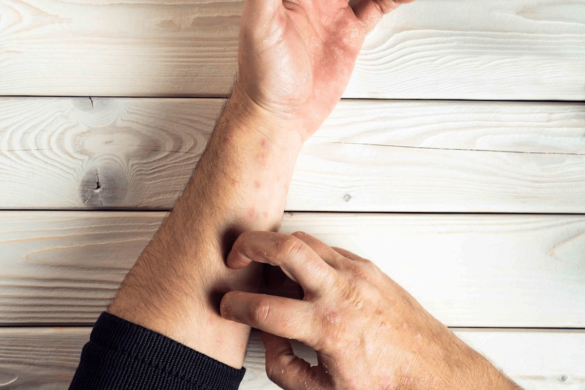 Complete What Does An Autoimmune Rash Look Like: Visual Guide