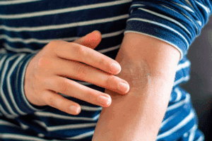 Key What Is Allopurinol And How Does It Treat Gout?