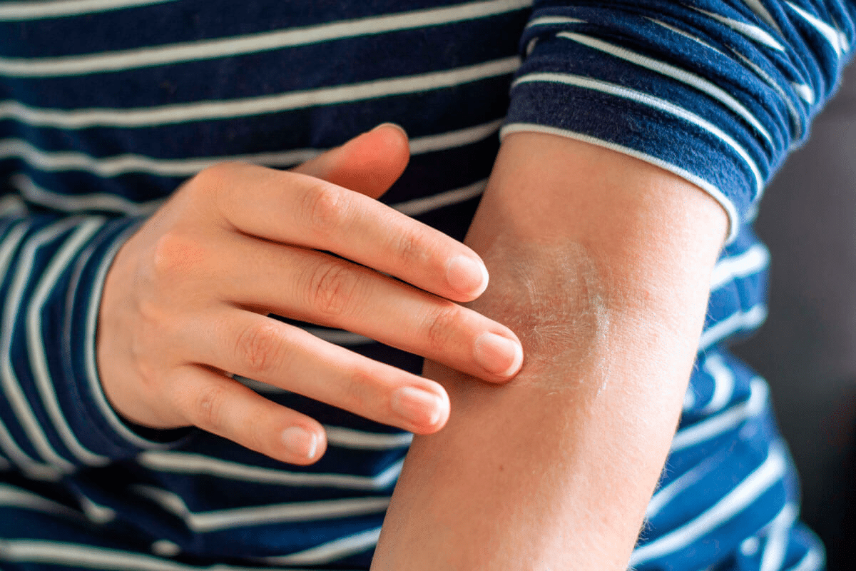 Amazing Autoimmune Rash On Arms: Which Diseases?