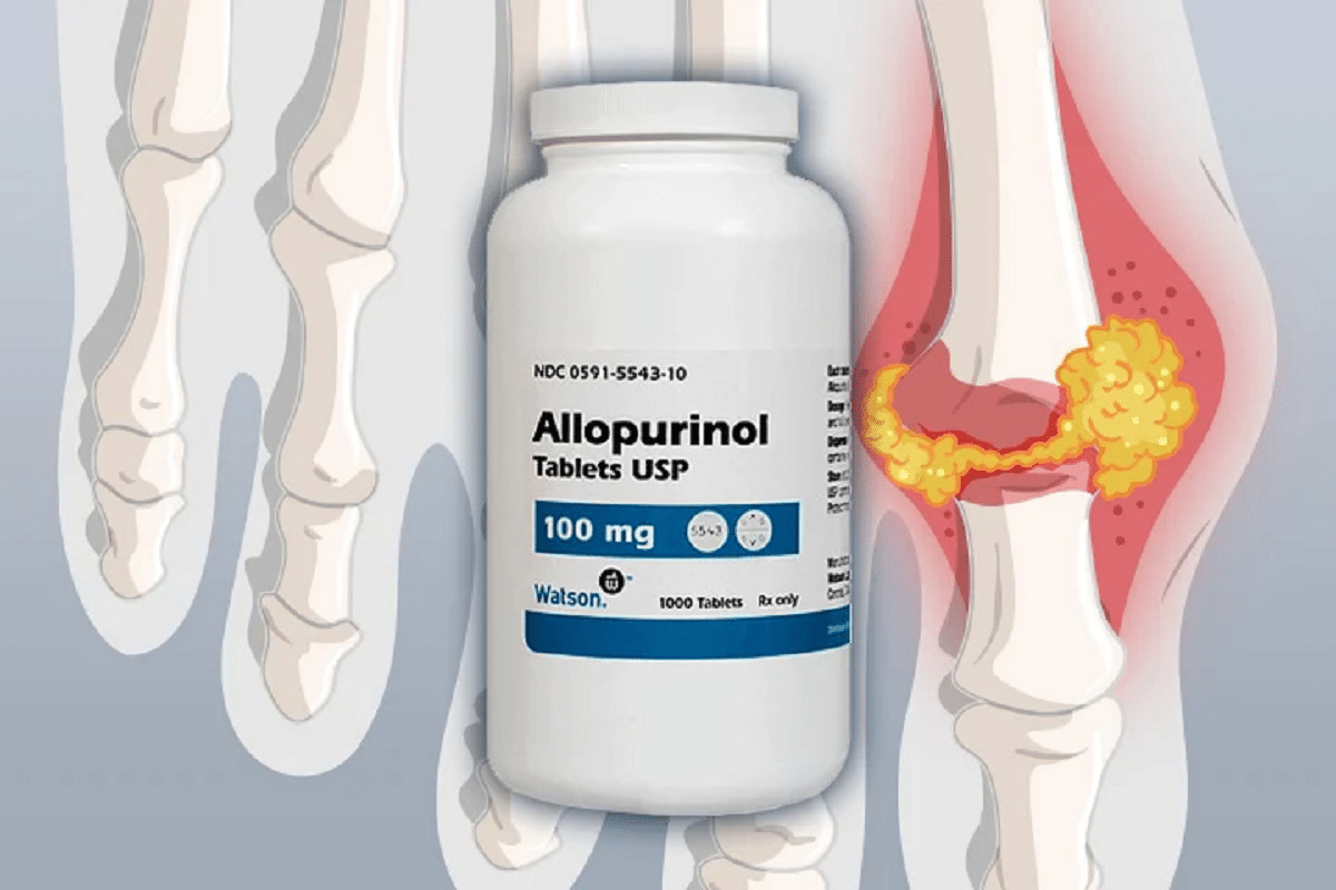 Valuable What To Avoid When Taking Allopurinol Safely