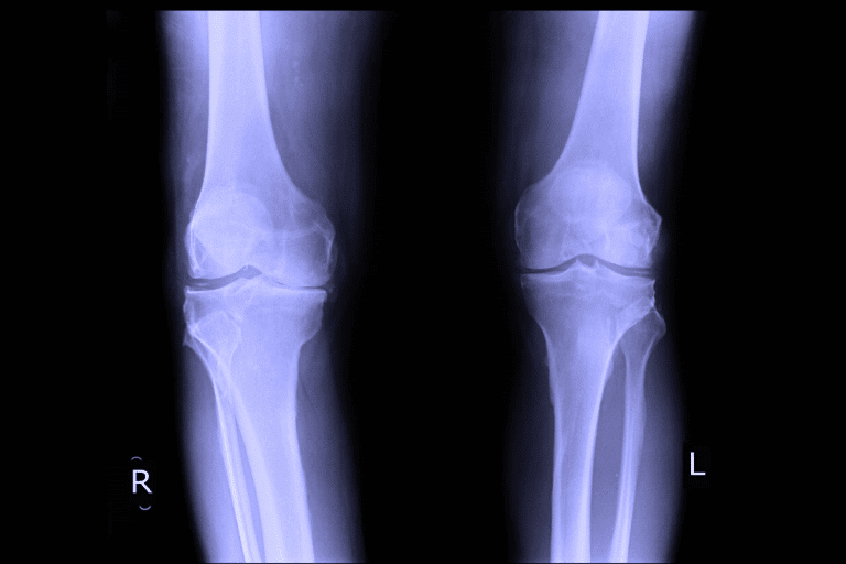 Valuable Treatment For Osteoarthritis Of The Knee Guide