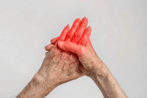 Sharp Is Ibuprofen Good For Gout: Safe Treatment Options