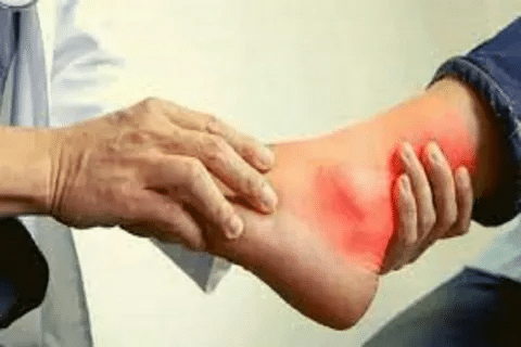 Insightful 7 Best Anti Inflammatory For Gout Relief