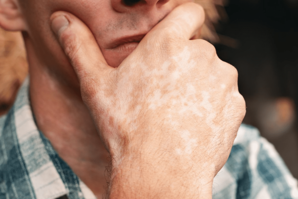 Essential Autoimmune Rash On Neck: Which Diseases?