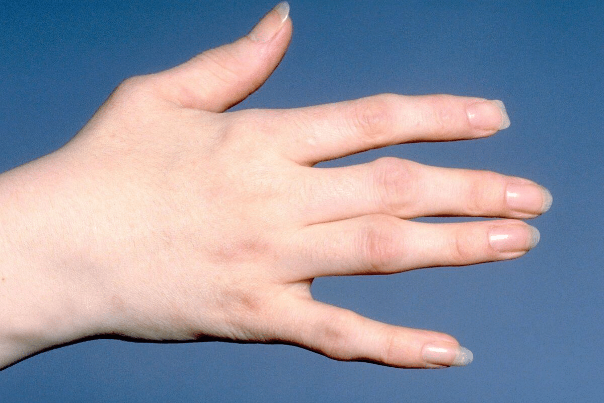 Valuable How Long Does A Rheumatoid Flare Up Last?