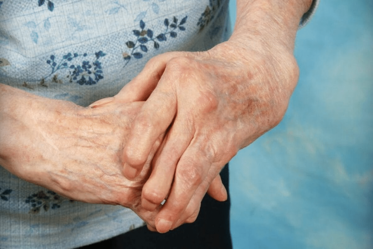 Valuable How Long Does A Rheumatoid Flare Up Last?