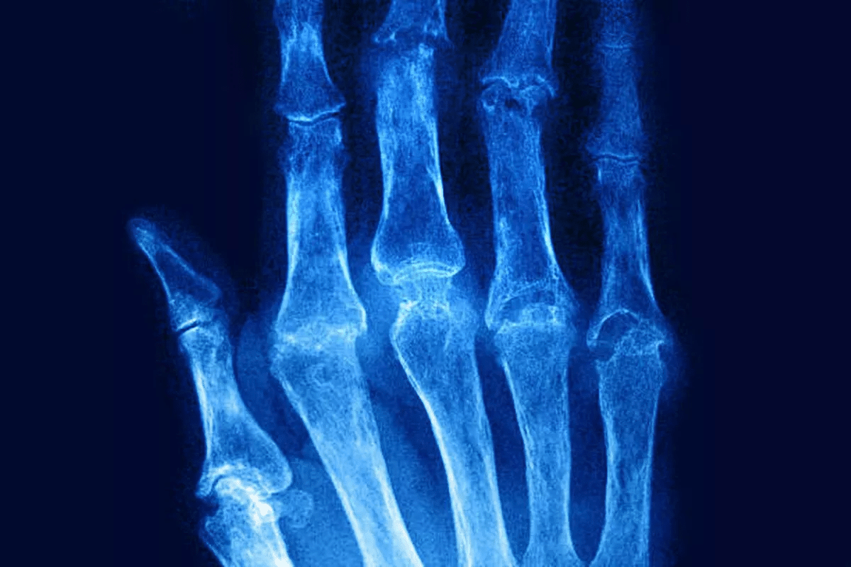 Valuable How Long Does A Rheumatoid Flare Up Last?