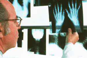 Profound Autoimmune Disease That Causes Hives & Treatment