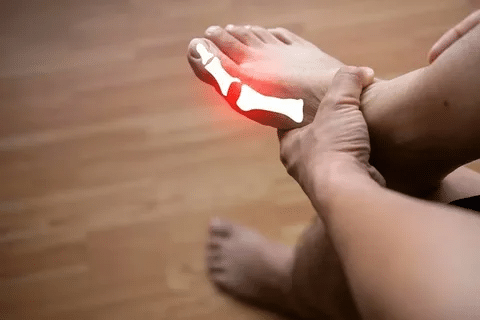 Guide Can Allopurinol For Gout Be Used During Attack?