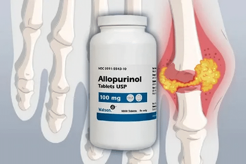 Profound Allopurinol 300 Mg: What Is It Used To Treat?