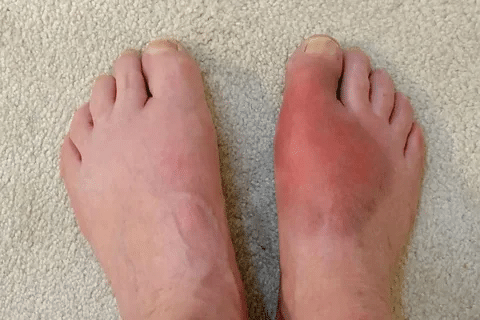 Simple Triggers Of Inflammatory Arthritis Flare Up 3 Simple Triggers Of Inflammatory Arthritis Flare Up