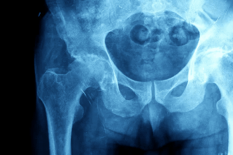 Complete Positive P ANCA And C ANCA Test Meaning 1 Complete Positive P ANCA And C ANCA Test Meaning