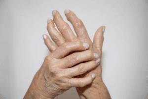Amazing Practical Guide For Living With Rheumatoid Arthritis