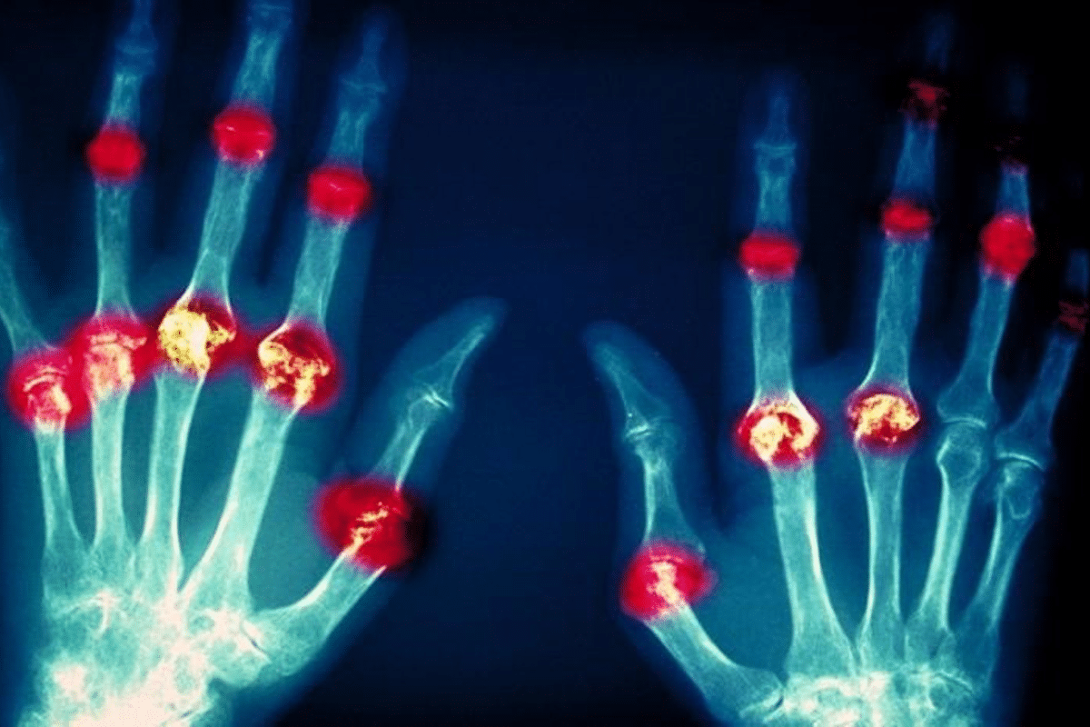 Key Rheumatoid Arthritis Prevalence: US Statistics
