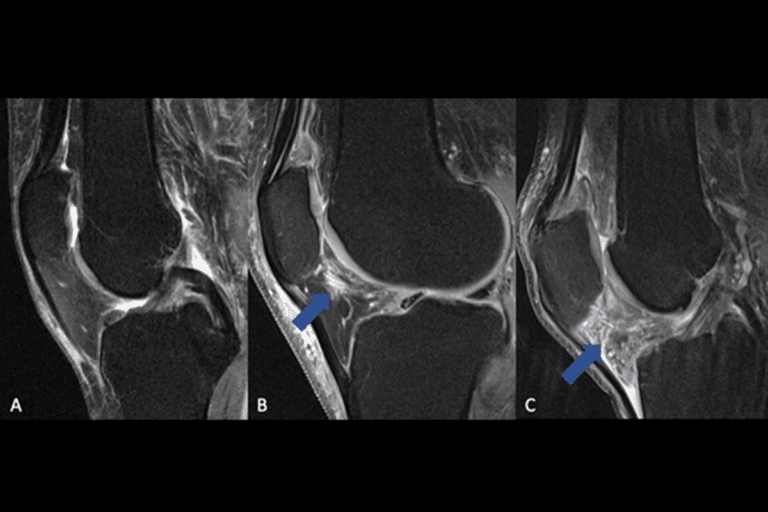 Insightful What Is The Medical Abbreviation For Rheumatoid Arthritis?