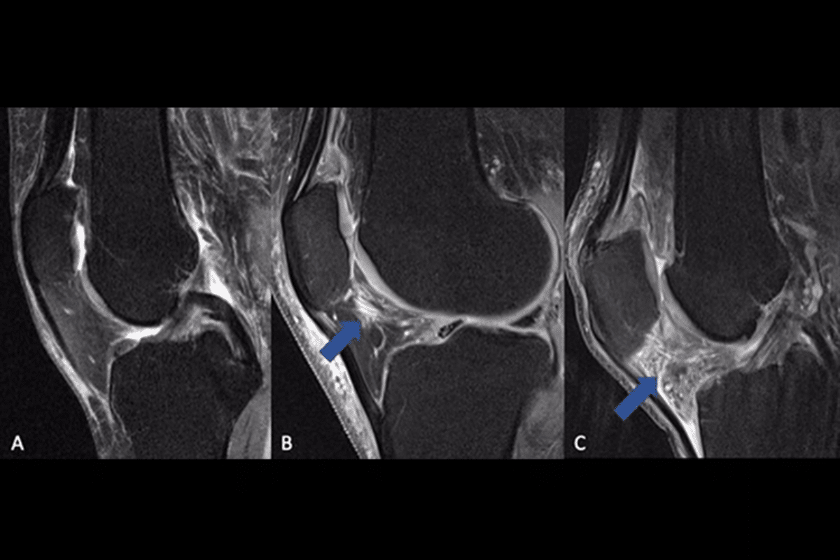 Insightful What Is The Medical Abbreviation For Rheumatoid Arthritis? 1 Insightful What Is The Medical Abbreviation For Rheumatoid Arthritis?