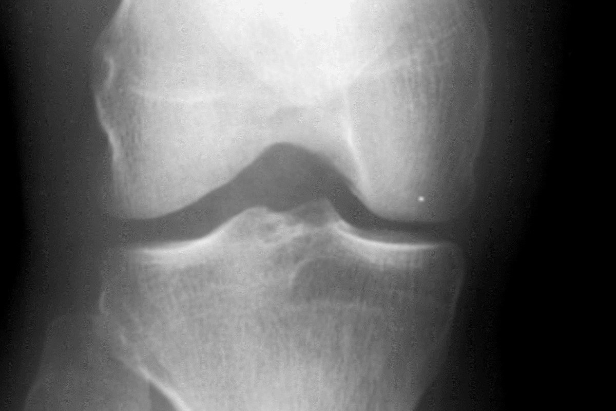 Profound 5 Steps: How Do You Reverse Bone Loss Naturally?