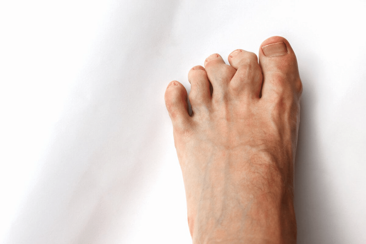 Guide Treat Foot Degenerative Arthritis: Complete Guide