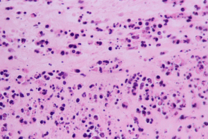 Sharp 5 Key Facts About P ANCA Vasculitis