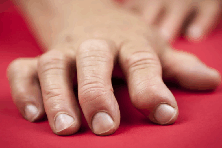 Amazing What Are The 4 Stages Of Rheumatoid Arthritis?