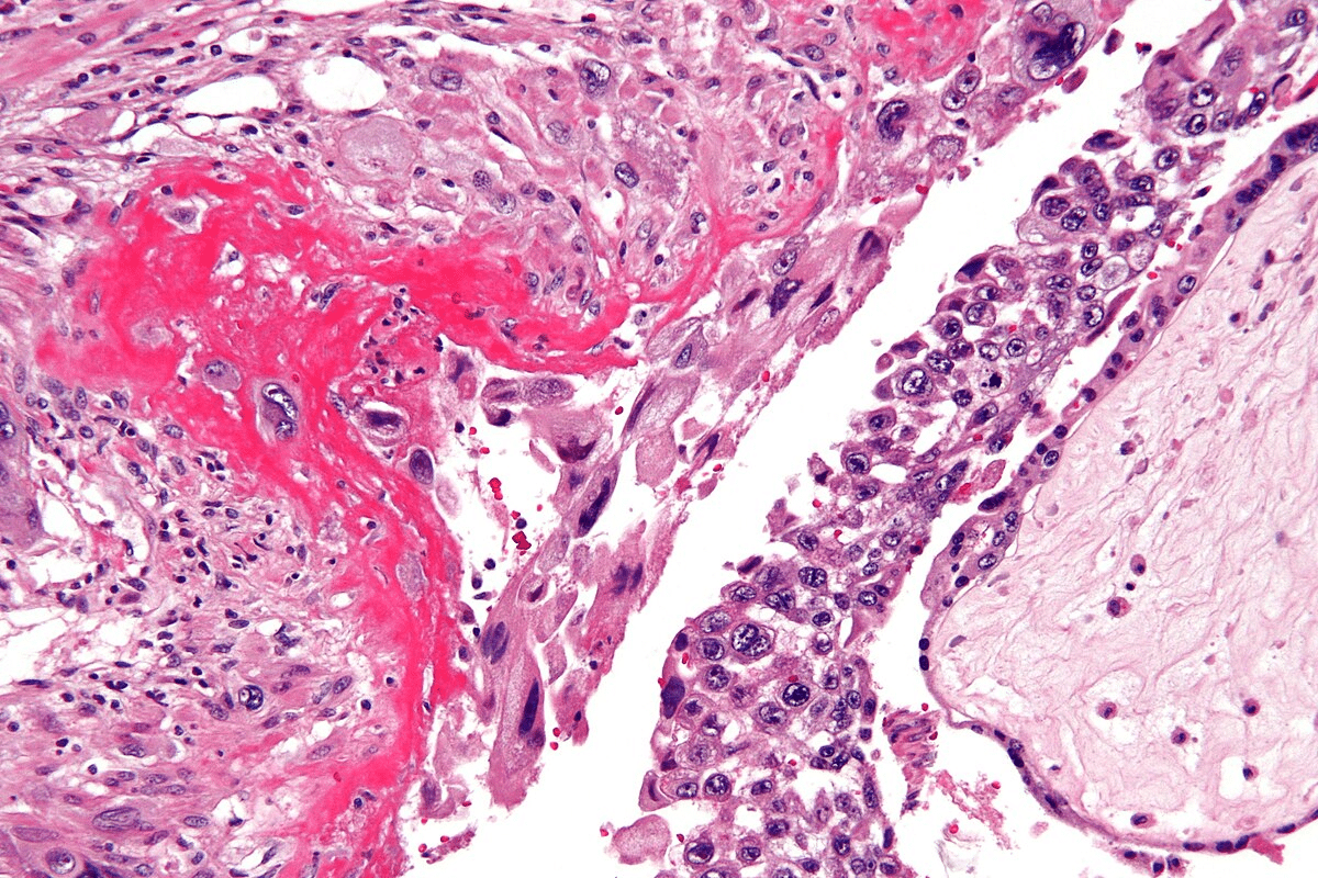 Complete 5 Key Facts About PANCA Vasculitis 3 Complete 5 Key Facts About PANCA Vasculitis