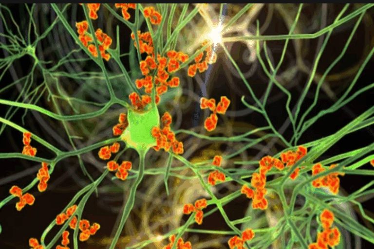 Amazing What Is ANCA-Associated Vasculitis?